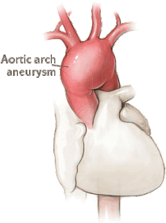 il_taa_arch_aneurysm